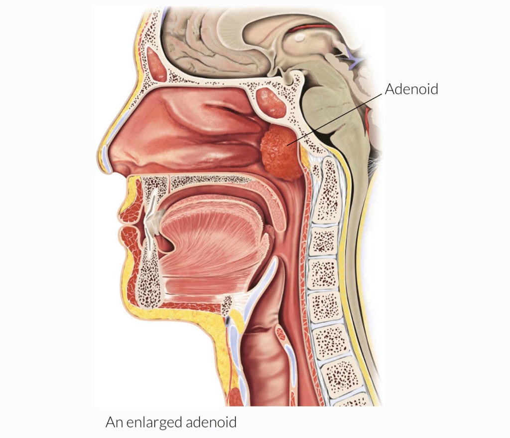 Adenoidectomy 1