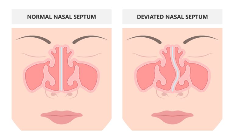 Self Pay Surgery Septoplasty