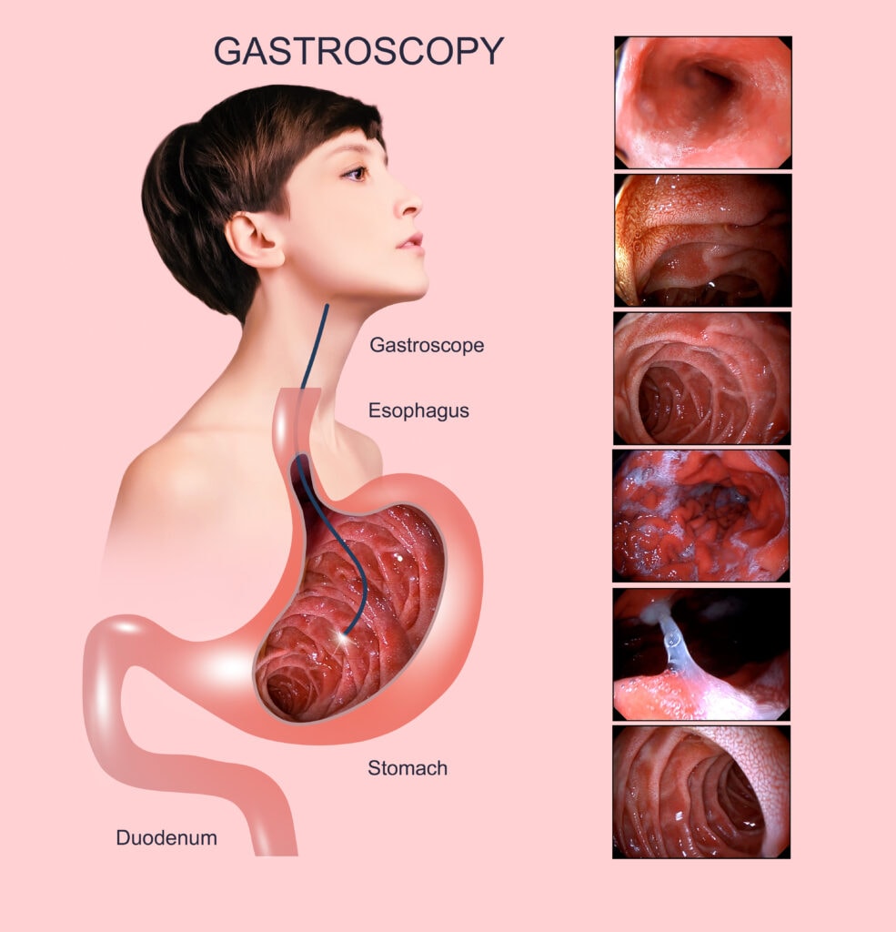 Digestive endoscopy or gastroscopy. Performing a gastroscopy procedure. Diagnostics of gastric diseases. Stomach health.