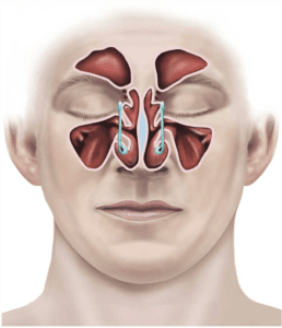 Endoscopic Sinus