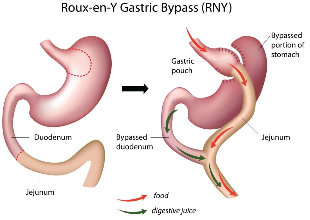 Roux-en-Y Gastric Bypass Self Pay Surgery