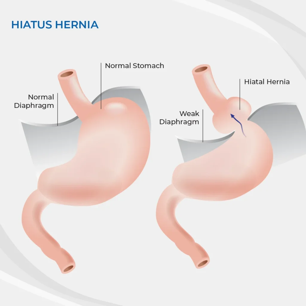 Hiatus hernia