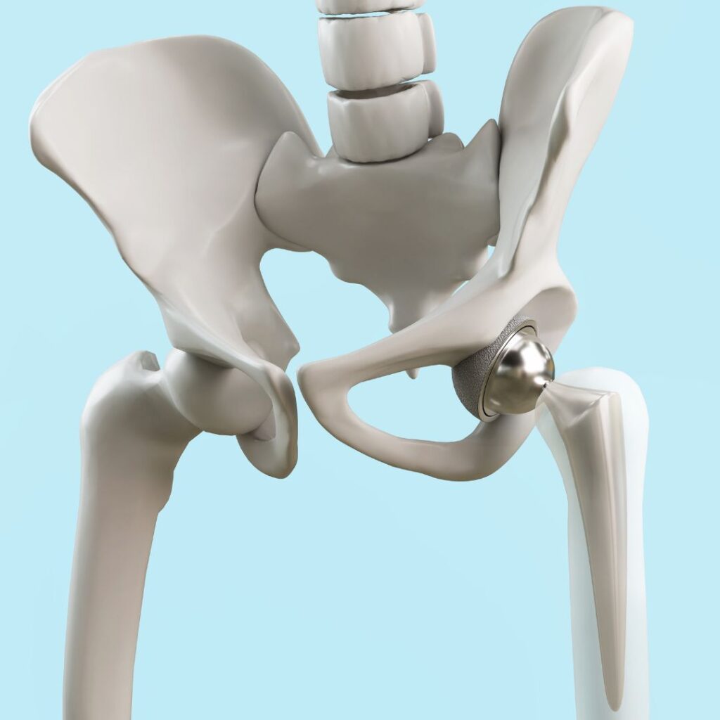 Self Pay Surgery offers state of the art hip replacements in Melbourne Victoria