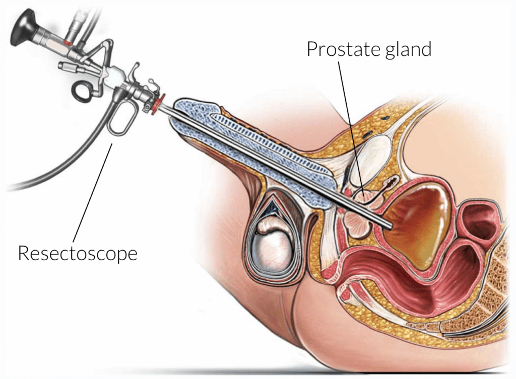 Transurethral Resection Of The Prostate TURP eido