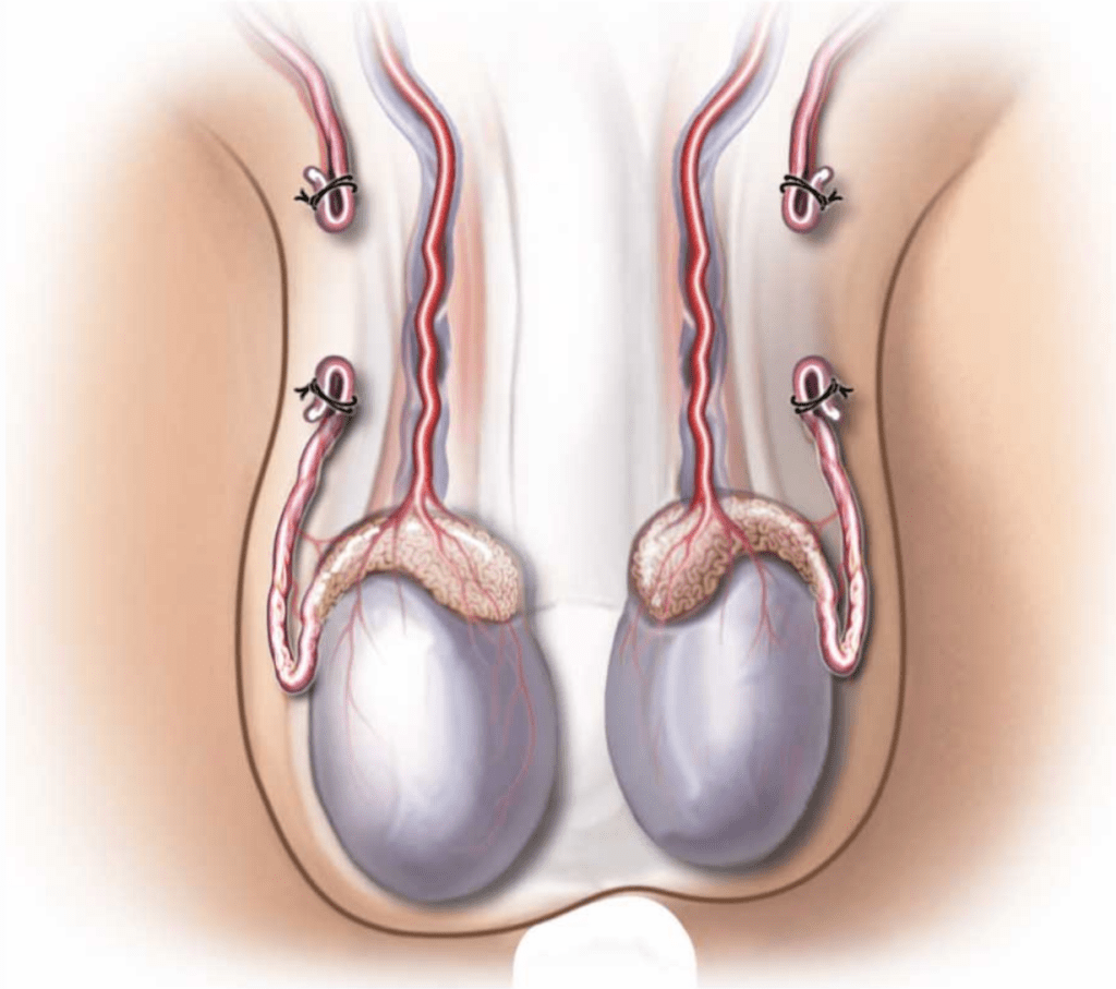 Vasectomy eido
