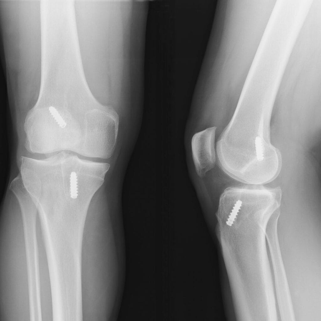 X-ray of knee with ACL reconstruction