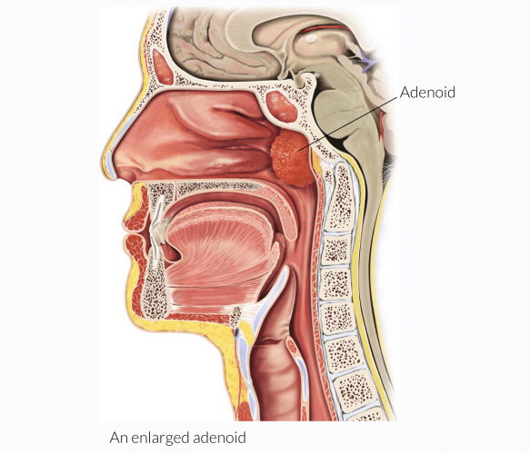 Adenoidectomy