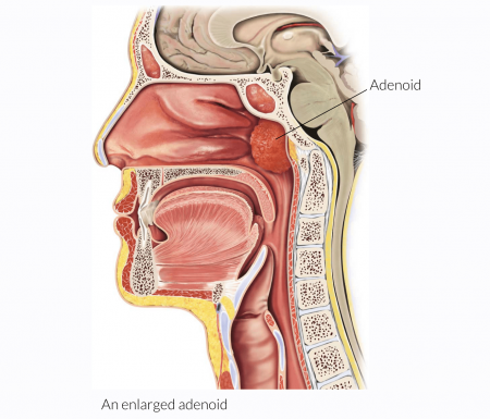 Adenoidectomy