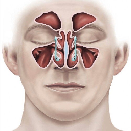 Endoscopic Sinus