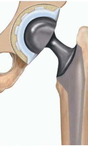 Total Hip Replacement-eido