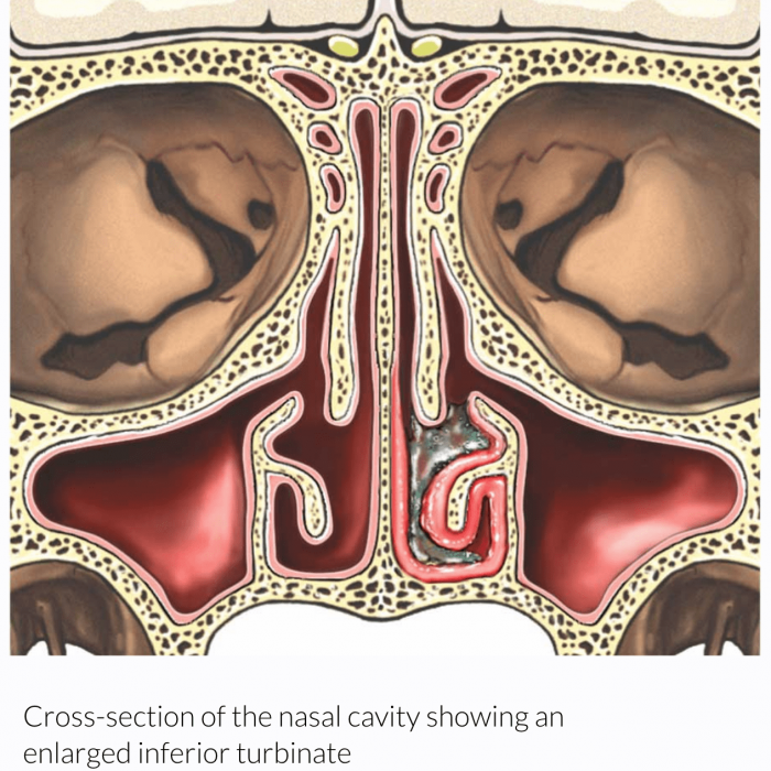 Turbinectomy