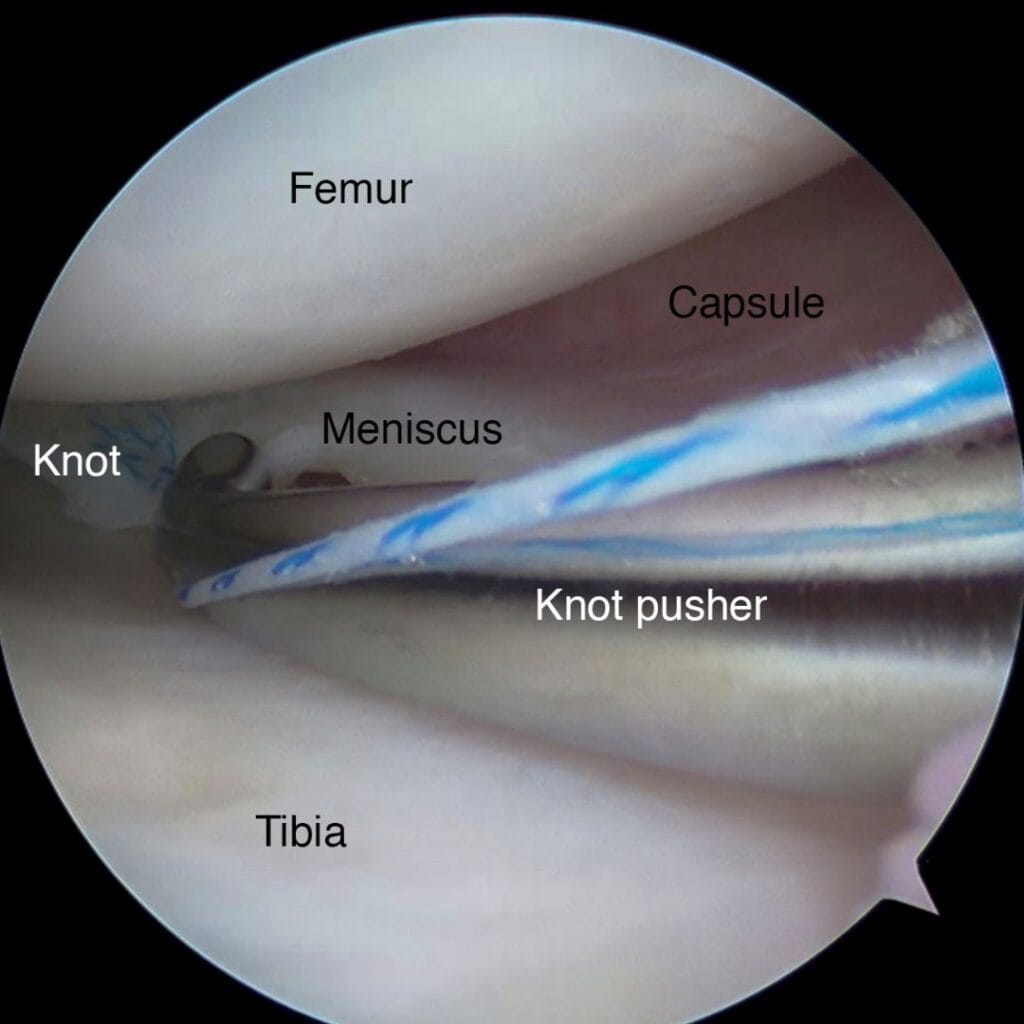 Arthroscopic view of a bucket handle tear of the medial meniscus of the right knee being repaired with an all inside technique